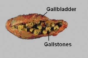 Gallstones; Biliary Calculi