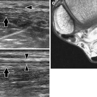 (PDF) Isolated tear of the plantaris tendon: Ultrasound and MRI appearance