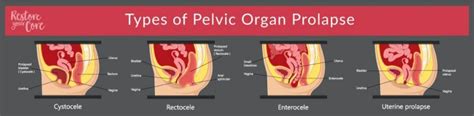 IS PELVIC FLOOR REPAIR MAJOR SURGERY? | PELVIC HEALTH GUIDE - RYC®