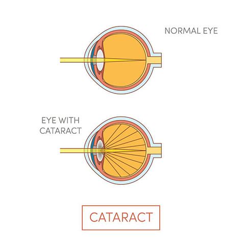 Royalty Free Cataract Clip Art, Vector Images & Illustrations - iStock