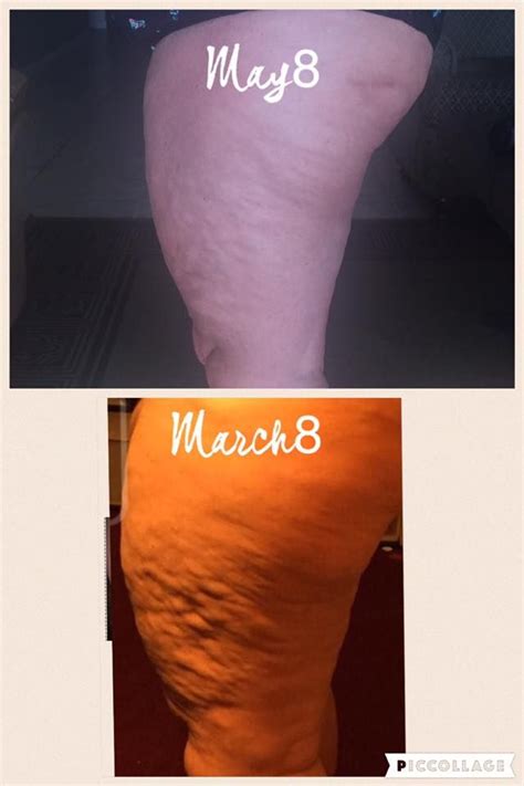 896 best images about FasciaBlaster® Transformations on Pinterest ...