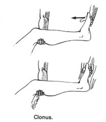 Clonus : Clinical Examination and Mechanism | Epomedicine