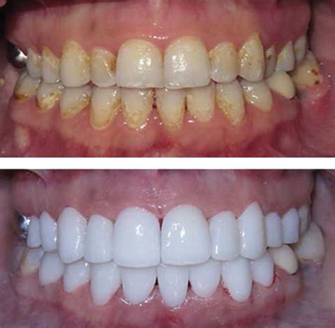 Zirconium Crowns and Bridges - Dentists Centurion | Centurion Dental Studio Dentists In Centurion