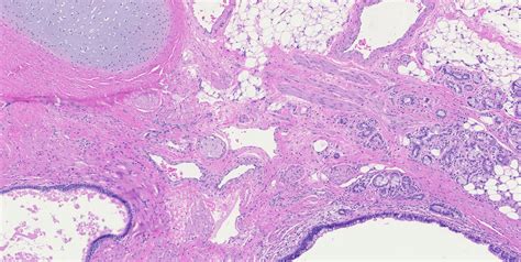 Teratoma Histology