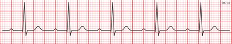 CV Physiology | Abnormal Rhythms - Definitions