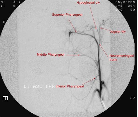 Ascending Pharyngeal Artery | neuroangio.org