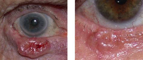 Nodular Basal Cell Carcinoma Of The Eyelid