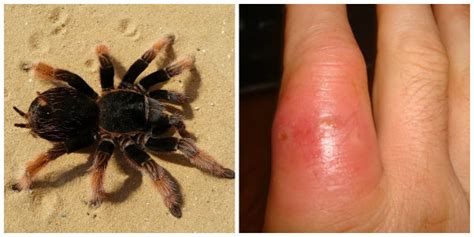 How to Identify a Spider Bite and Treat It | TruePrepper