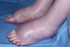 Turf Toe Causes, Symptoms, Diagnosis and Treatment - Natural Health News