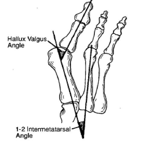 The severity of hallux valgus is often diagnosed by the hallux valgus... | Download Scientific ...