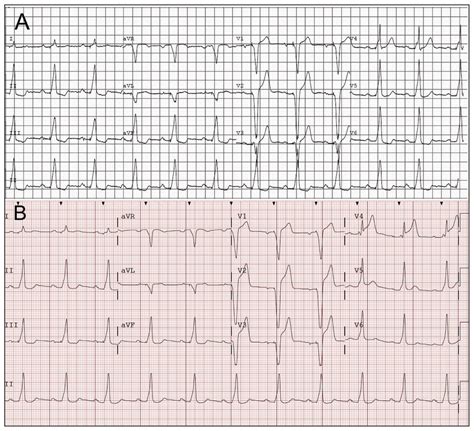 Sgarbossa criteria for acute myocardial infarction | CMAJ