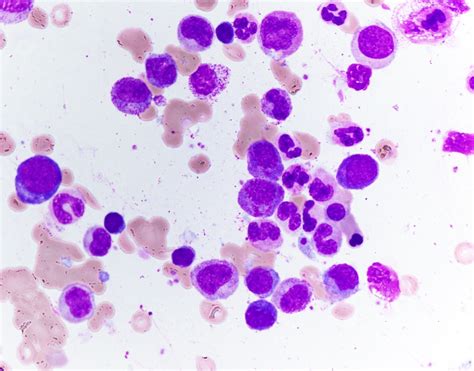 Pathology Outlines - Chronic neutrophilic leukemia