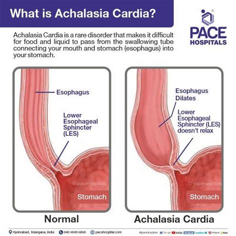 Achalasia Cardia: Symptoms, Diagnosis and Treatment