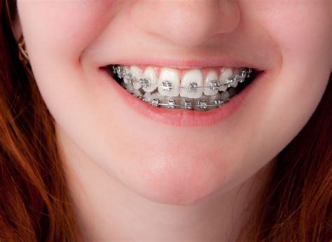 Twisted Teeth: 3 Reasons Your Children Need Orthodontic Treatment