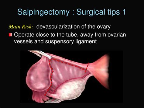 PPT - Update on Reproductive Surgery PowerPoint Presentation, free ...