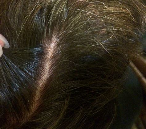 Flaky scalp? This treatment is a revelation | Figaro London