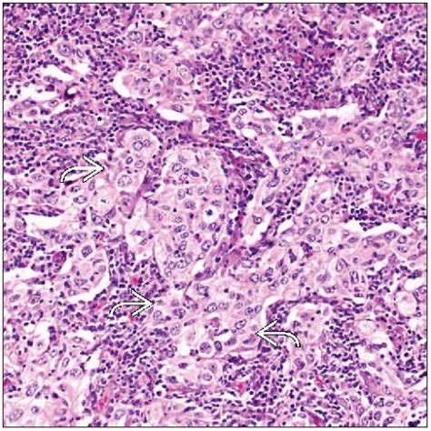 Medullary Carcinoma | Basicmedical Key