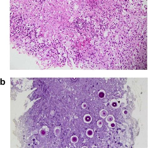 Histopathology of CT-guided biopsy of lung nodule from left lower lobe.... | Download Scientific ...