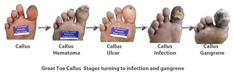 Diabetic Foot Gangrene stages Great Toe Tip - Podiatry Doctor