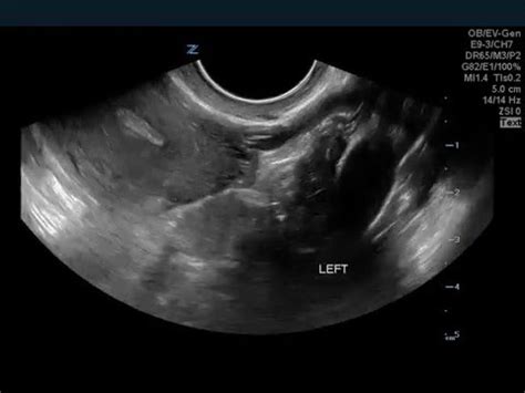 Lt Ovarian Cyst Causing LLQ-Pelvic Pain in Teenaged Girl - YouTube