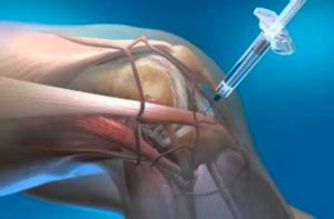 Stem Cell Injection Alternative To Knee Replacement? - SeniorsSkiing.com