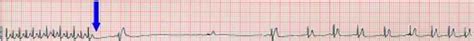 Adenosine for wide-complex tachycardia - diagnostic? - Rogue Medic