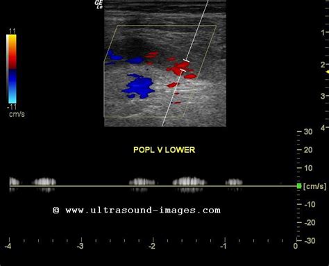 cochinblogs: Ultrasound imaging of popliteal vein thrombosis