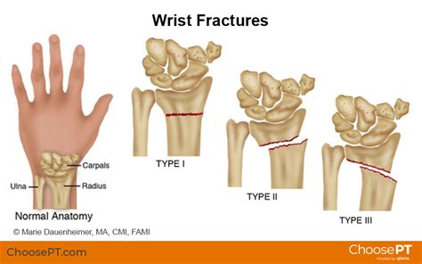 How Much Force Does It Take to Break a Wrist