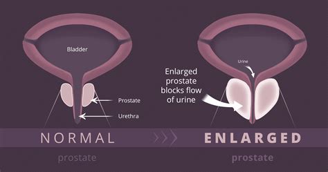 Benign Prostatic Hyperplasia (BPH) - Gaytri Manek (Formerly Gandotra), MD