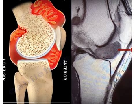 Pigmented Villonodular Synovitis — OrthopaedicPrinciples.com