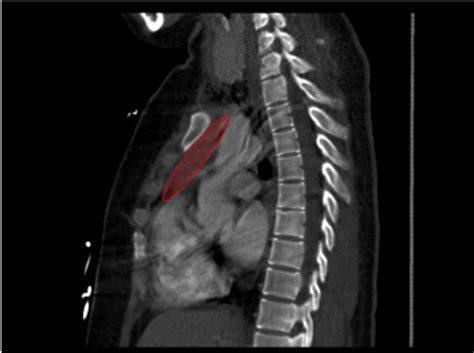 A rare complication of mediastinal mass biopsy