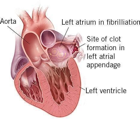 Left Atrial Appendage Occlusion - Phoenix, AZ & Tempe, AZ: Arizona ...