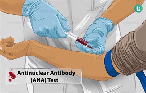 ANA (Antinuclear Antibody) Test: Procedure, Purpose, Results, Cost ...