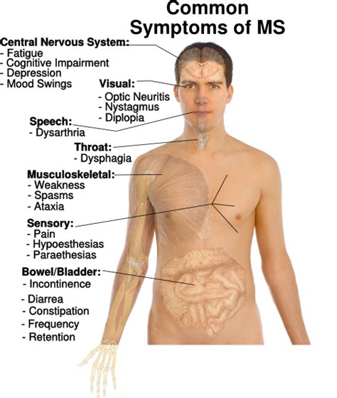 Common Symptoms Of Ms Clip Art at Clker.com - vector clip art online ...