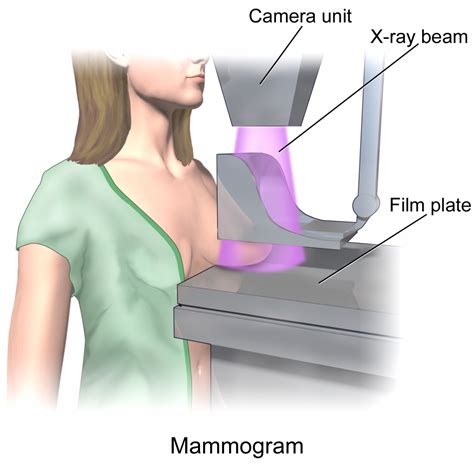 Mammography – Undergraduate Diagnostic Imaging Fundamentals