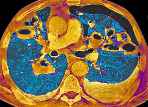 Bacterial pneumonia, coloured CT scan - Stock Image - C034/5695 - Science Photo Library