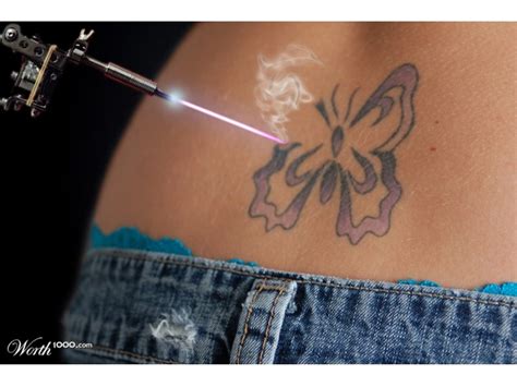 PAINLESS TATTOO REMOVAL | Canton, MA Patch