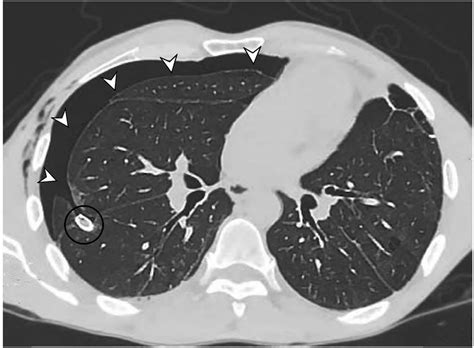 Chest CT showing right-sided pneumothorax (white arrows) predominantly... | Download Scientific ...