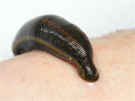 WATCH: See How Leeches Can Be A Surgeon's Sidekick | NCPR News