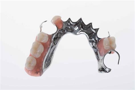 Cobalt Chrome Partial Dentures Tweed Heads | Costs