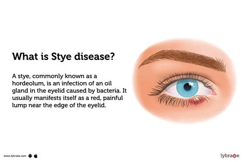 Stye: Causes, Symptoms, Treatment And Cost