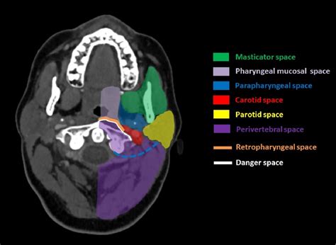 Figure 5 from Computed tomography imaging of deep neck space infections ...