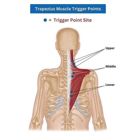 Trapezius Muscle Trigger Points