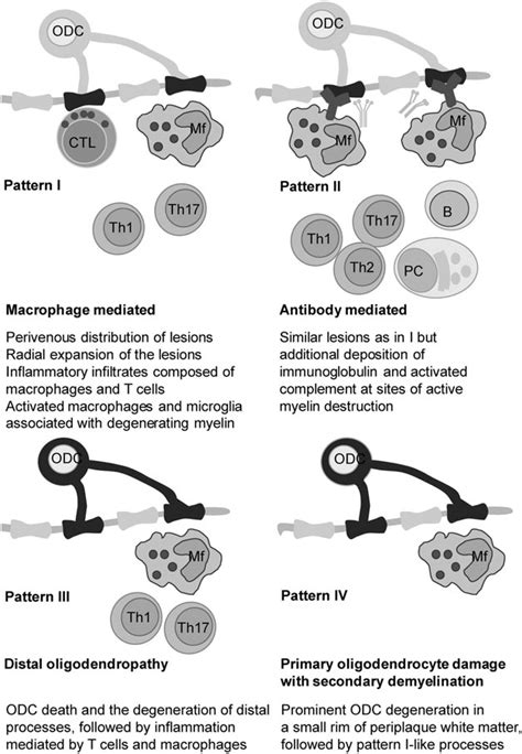 Four histopathological subtypes of MS lesions. Histopathological... | Download Scientific Diagram