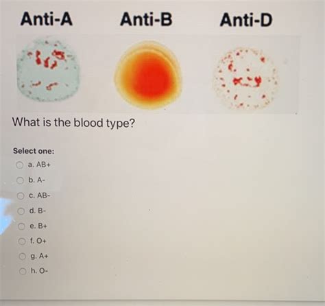 Solved Anti-A Anti-B Anti-D What is the blood type? Select | Chegg.com