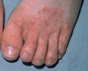 Foot Rash: Causes, Symptoms & Treatment