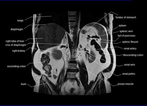 anatomy human abdomen | MRI abdomen coronal anatomy | free cross ...