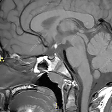 Small Pituitary and Ectopic Neurohypophysis, MRI - Stock Image - C030/6451 - Science Photo Library