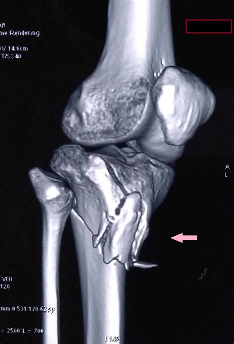 Cureus | Tibial Plateau Fracture with Avulsion Fracture of Tibial Tuberosity: A Case Report and ...