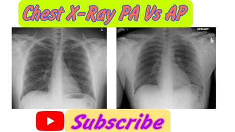 What Is Pa Chest X Ray at Bessie Cindy blog